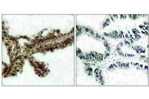 Immunohistochemical analysis of paraffin-embedded human lung carcinoma tissue, using Akt (phospho-Thr308) antibody(E011055). (AKT1 Antikörper  (pThr308))