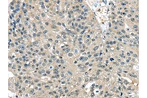 The image on the left is immunohistochemistry of paraffin-embedded Human breast cancer tissue using ABIN7128053(TXNDC17 Antibody) at dilution 1/30, on the right is treated with fusion protein. (TXNDC17 Antikörper)