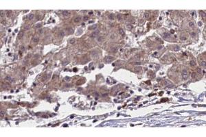 ABIN6273958 at 1/100 staining Human liver cancer tissue by IHC-P. (OR51L1 Antikörper  (Internal Region))