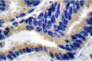 Immunohistochemistry analyzes of Actived-Caspase-3 p17 Antibody in paraffin-embedded human lung carcinoma tissue. (Caspase 3 Antikörper)