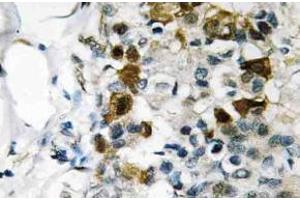 Immunohistochemistry (IHC) analyzes of p-HSP27 antibody in paraffin-embedded human breast carcinoma tissue. (HSP27 Antikörper  (pSer82))