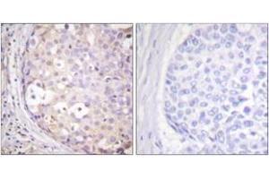 Immunohistochemistry analysis of paraffin-embedded human breast carcinoma tissue, using PKC-pan (Ab-Thr497) Antibody. (PKC Antikörper  (Thr497))