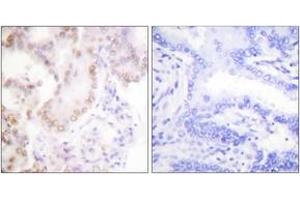 Immunohistochemistry analysis of paraffin-embedded human lung carcinoma tissue, using Cyclin G Antibody. (Cyclin G1 Antikörper  (AA 161-210))