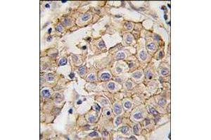 Formalin-fixed and paraffin-embedded human breast carcinoma tissue reacted with HER2 antibody, which was peroxidase-conjugated to the secondary antibody, followed by DAB staining. (ErbB2/Her2 Antikörper)