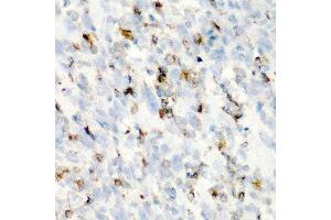 Immunohistochemistry of paraffin-embedded human esophageal cancer using CD68 antibody at dilution of 1:200 (40x lens).
