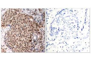 Immunohistochemical analysis of paraffin-embedded human breast carcinoma tissue, using MAPKAPK-2 (Phospho-Thr334) antibody (E011308). (MAPKAP Kinase 2 Antikörper  (pThr334))