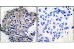 Immunohistochemistry analysis of paraffin-embedded human breast carcinoma, using Filamin A (Phospho-Ser2152) Antibody. (Filamin A Antikörper  (pSer2152))
