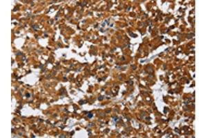 The image on the left is immunohistochemistry of paraffin-embedded Human thyroid cancer tissue using ABIN7128790(CAT Antibody) at dilution 1/40, on the right is treated with fusion protein.