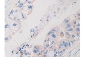 Detection of PDHX in Human Bile duct cancer Tissue using Polyclonal Antibody to Pyruvate Dehydrogenase Complex Component X (PDHX)