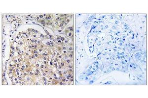 Immunohistochemistry analysis of paraffin-embedded human breast carcinoma tissue using GPR116 antibody. (G Protein-Coupled Receptor 116 Antikörper  (C-Term))