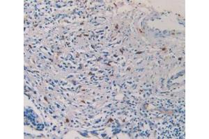 IHC-P analysis of Human Prostate Gland Cancer Tissue, with DAB staining. (TPSAB1 Antikörper  (AA 161-262))