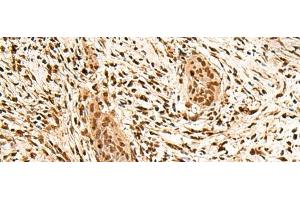 Immunohistochemistry of paraffin-embedded Human esophagus cancer tissue using PPM1G Polyclonal Antibody at dilution of 1:40(x200) (PPM1G Antikörper)