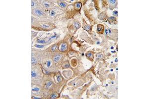 Formalin-fixed and paraffin-embedded human lung carcinoma tissue reacted with CYP2W1 antibody (N-term), which was peroxidase-conjugated to the secondary antibody, followed by DAB staining.