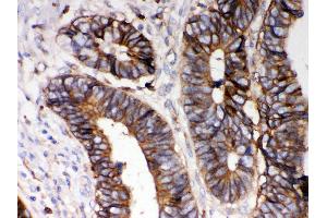 Anti- HLA-A Picoband antibody,IHC(P) IHC(P): Human Intestinal Cancer Tissue