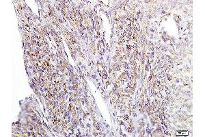 Formalin-fixed and paraffin embedded human cervical carcinoma labeled with Anti APE/Girdin Polyclonal Antibody, Unconjugated (ABIN755587) at 1:200 followed by conjugation to the secondary antibody and DAB staining (Girdin Antikörper  (AA 1401-1500))