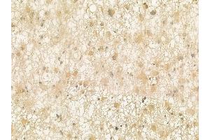 ABIN6262119 and ABIN6273252 at 1/100 staining human astrocytoma by IHC-P. (GSTM3 Antikörper  (C-Term))
