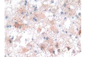 Detection of NCAD in Human Glioma Tissue using Polyclonal Antibody to N-cadherin (NCAD) (N-Cadherin Antikörper  (AA 685-784))