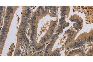 Immunohistochemistry of paraffin-embedded Human colon cancer using KCNA7 Polyclonal Antibody at dilution of 1:40 (KCNA7 Antikörper)