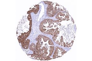 Ovary Mucinous ovarian cancer showing strong villin immunostaining (Rekombinanter Villin 1 Antikörper  (AA 600-700))