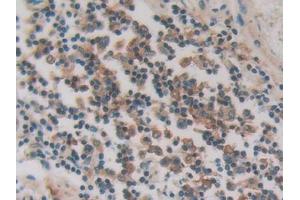 DAB staining on IHC-P; Samples: Human Stomach cancer Tissue (PKIG Antikörper  (AA 1-76))