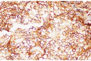Immunohistochemistry of paraffin-embedded Human kidney cancer using FOLH1 Polycloanl Antibody at dilution of 1:200 (PSMA Antikörper)