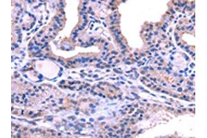 The image on the left is immunohistochemistry of paraffin-embedded Human thyroid cancer tissue using ABIN7131472(TRIM14 Antibody) at dilution 1/40, on the right is treated with fusion protein. (TRIM14 Antikörper)