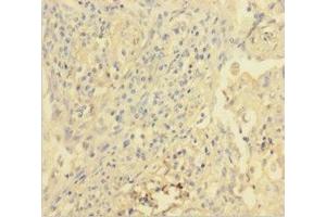 Immunohistochemistry of paraffin-embedded human lung cancer using ABIN7175384 at dilution of 1:100 (VEGFR2/CD309 Antikörper  (AA 20-764))