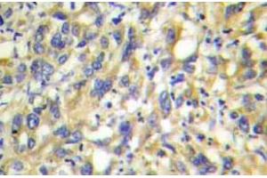 Immunohistochemistry  (IHC) analyzes of MKP-4 antibody in paraffin-embedded human liver carcinoma tissue. (DUSP9 Antikörper)