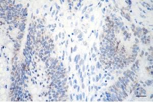 Immunohistochemistry was performed on paraffin-embedded human sigmoid colon carcinoma using GTF2F2 antibody (ABIN7798708), 1:200). (Rekombinanter GTF2F2 Antikörper)