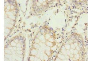 Immunohistochemistry of paraffin-embedded human colon cancer using ABIN7159199 at dilution of 1:100 (REC8 Antikörper  (AA 1-270))