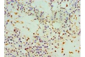 Immunohistochemistry of paraffin-embedded human breast cancer using ABIN7143947 at dilution of 1:100 (SNCA Antikörper  (AA 61-140))