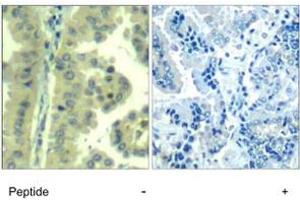 Imunohistochemical analysis of paraffin-embedded human lung carcinoma tissue, using EIF4G1 polyclonal antibody . (EIF4G1 Antikörper  (Ser1232))