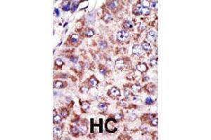 Formalin-fixed and paraffin-embedded human hepatocellular carcinoma tissue reacted with FDFT1 polyclonal antibody  , which was peroxidase-conjugated to the secondary antibody, followed by DAB staining . (FDFT1 Antikörper  (N-Term))