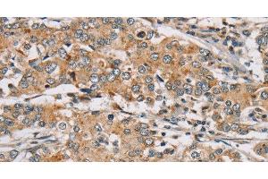 Immunohistochemistry of paraffin-embedded Human liver cancer tissue using RAB24 Polyclonal Antibody at dilution 1:45 (RAB24 Antikörper)