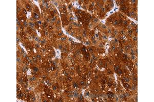 Immunohistochemistry of Human gastric cancer using HSPB6 Polyclonal Antibody at dilution of 1:40