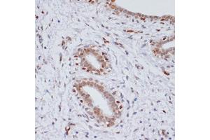 Immunohistochemistry of paraffin-embedded human breast cancer using TriMethyl-Histone H3-K27 antibody (ABIN3023268, ABIN3023269, ABIN3023270, ABIN1513002 and ABIN6219521) at dilution of 1:100 (40x lens). (Histone 3 Antikörper  (H3K27me))