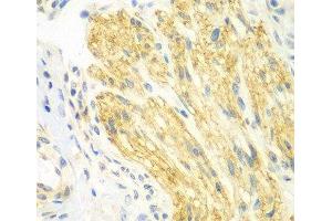 Immunohistochemistry of paraffin-embedded Human gastric cancer using PTK6 Polyclonal Antibody at dilution of 1:100 (40x lens). (PTK6 Antikörper)