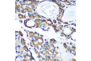 Immunohistochemistry of paraffin-embedded Human thyroid cancer using PDXDC1 Rabbit pAb (ABIN7269759) at dilution of 1:100 (40x lens). (PDXDC1 Antikörper  (AA 489-788))