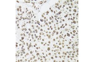 Immunohistochemistry of paraffin-embedded human esophageal cancer using SFPQ antibody (ABIN5970351) at dilution of 1/100 (40x lens).