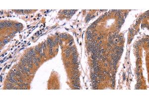 Immunohistochemistry of paraffin-embedded Human colon cancer tissue using CRISP3 Polyclonal Antibody at dilution 1:50 (CRISP3 Antikörper)