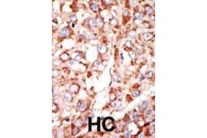 Formalin-fixed and paraffin-embedded human cancer tissue reacted with the primary antibody, which was peroxidase-conjugated to the secondary antibody, followed by DAB staining. (Acsl3 Antikörper  (N-Term))