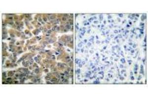 Immunohistochemical analysis of paraffin-embedded human breast carcinoma tissue using GR (Ab-211) antibody. (Glucocorticoid Receptor Antikörper  (Ser211))
