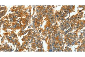 Immunohistochemistry of paraffin-embedded Human gastric cancer using ASNS Polyclonal Antibody at dilution of 1:60 (Asparagine Synthetase Antikörper)