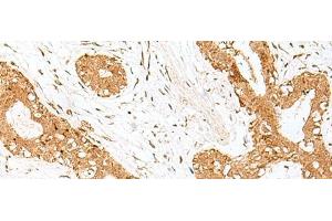 Immunohistochemistry of paraffin-embedded Human breast cancer tissue using GOLGA7 Polyclonal Antibody at dilution of 1:40(x200) (Golgin A7 Antikörper)