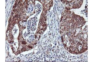 Immunohistochemical staining of paraffin-embedded Carcinoma of Human pancreas tissue using anti-NLN mouse monoclonal antibody.