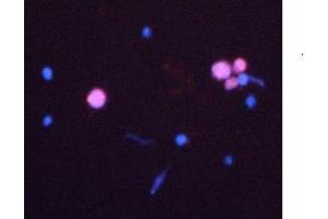 Immunofluorescent Caspase 3 detection in HeLa cells after induction of apoptosis (red fluorescence).