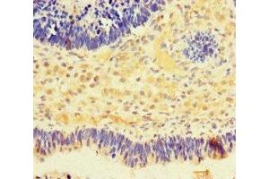 Immunohistochemistry of paraffin-embedded human ovarian cancer using ABIN7161580 at dilution of 1:100