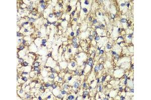 Immunohistochemistry of paraffin-embedded Human kidney cancer using PTGES2 Polyclonal Antibody at dilution of 1:100 (40x lens). (PTGES2 Antikörper)