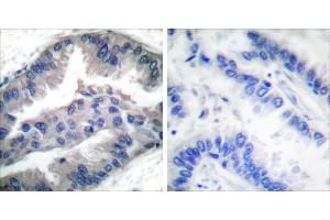 P-peptide - +Immunohistochemical analysis of paraffin-embedded human lung carcinoma tissue using BIK (Phospho-Thr33) antibody (#A0053). (BIK Antikörper  (pThr33))