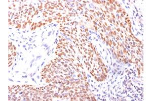 Formalin-fixed, paraffin-embedded Lung Squamous Cell Carcinoma stained with p40 Rabbit Polyclonal Antibody. (p63 Antikörper  (AA 5-17))